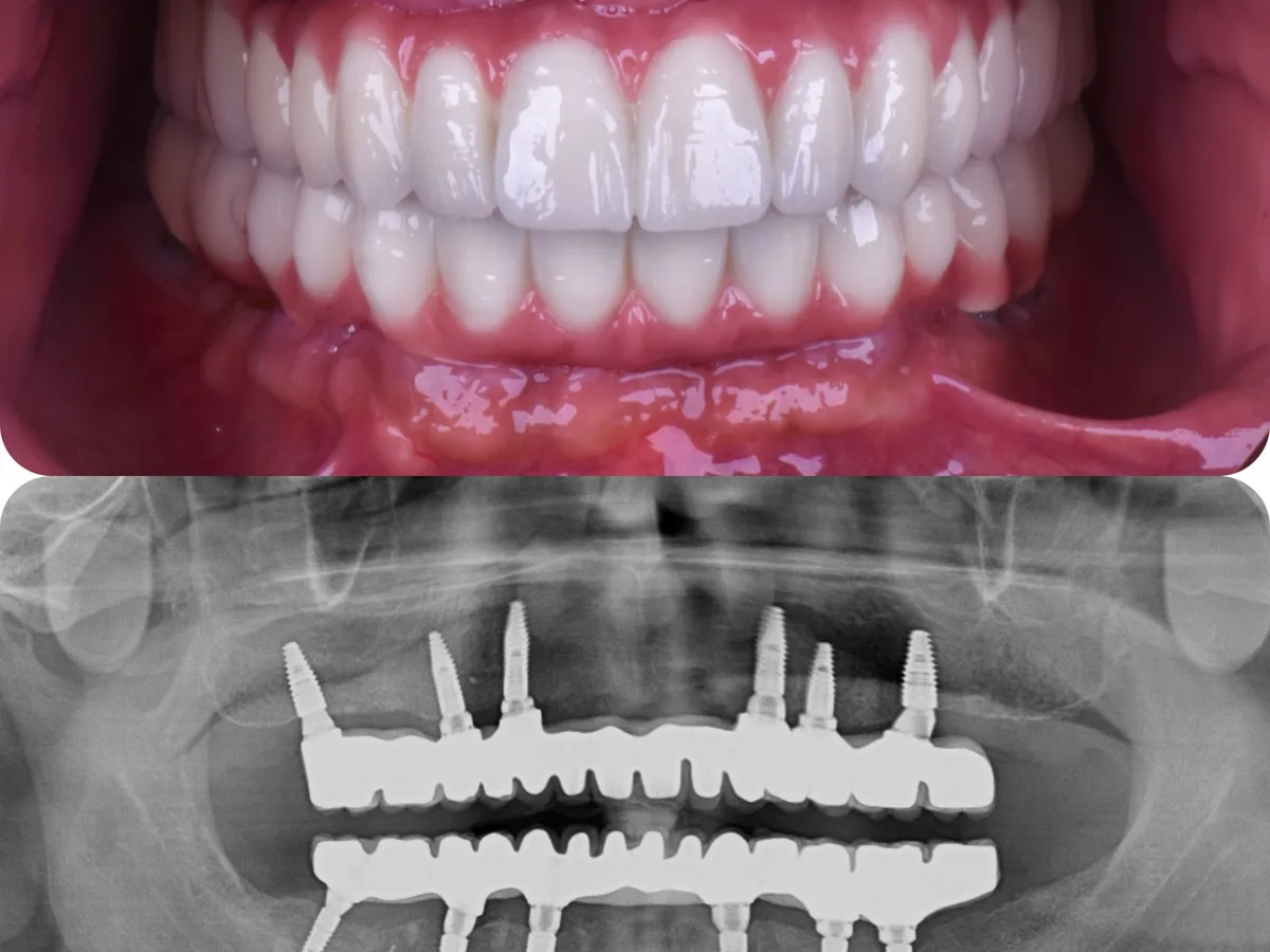 Prothèses sur six implants – arcade complète en zircone en Turquie
