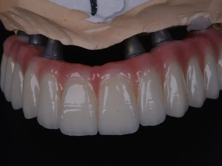 Système à six implants – comparaison des solutions d'arcade