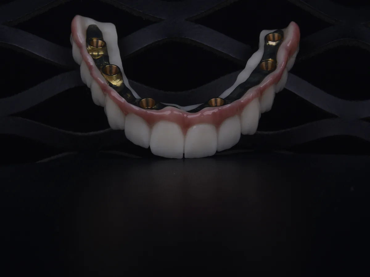 Résultat à six implants Istanbul – sourire fixe sur arcade complète