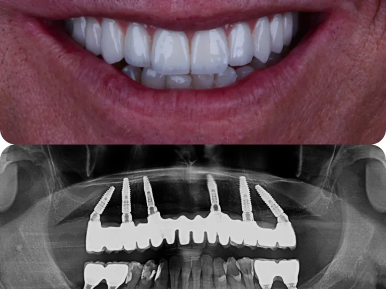 Déroulé du traitement à six implants chez CityDent Istanbul