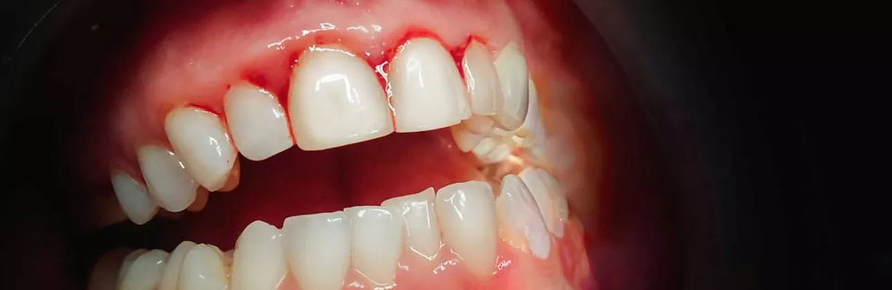 Bleeding gums showing inflamed red gum tissue around teeth