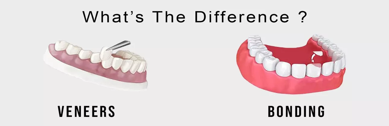 Dental bonding vs veneers comparison at CityDent Istanbul
