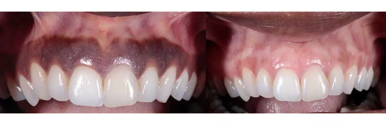 Dark gum discolouration — CityDent Istanbul gum assessment