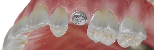 Chirurgie implantaire flapless par technique du punch gingival à Istanbul chez CityDent