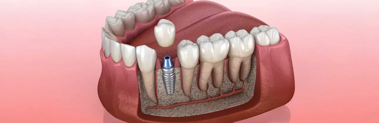 Implant-supported crown problems — CityDent Istanbul