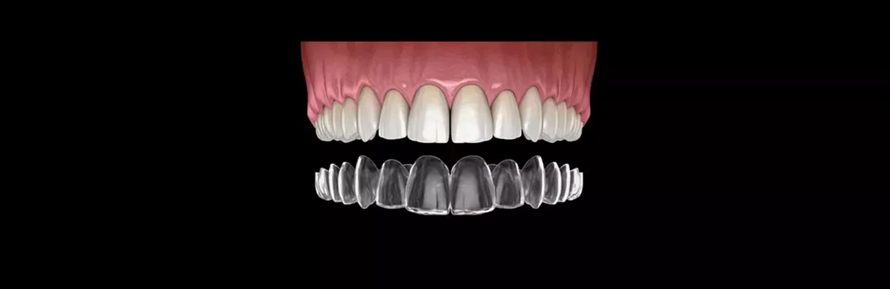Custom night guard treatment Istanbul — CityDent dental clinic
