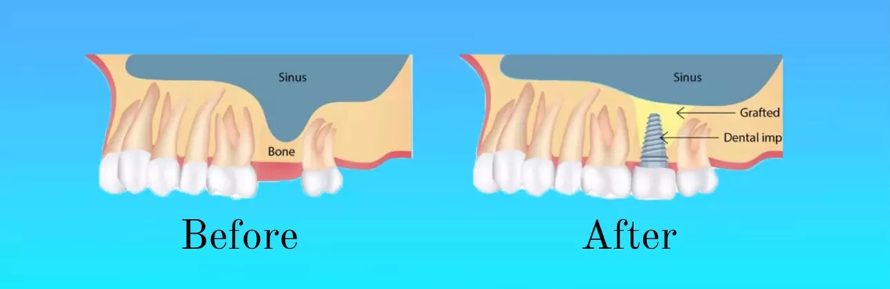 Sinus lift surgery Istanbul — bone graft procedure for dental implants
