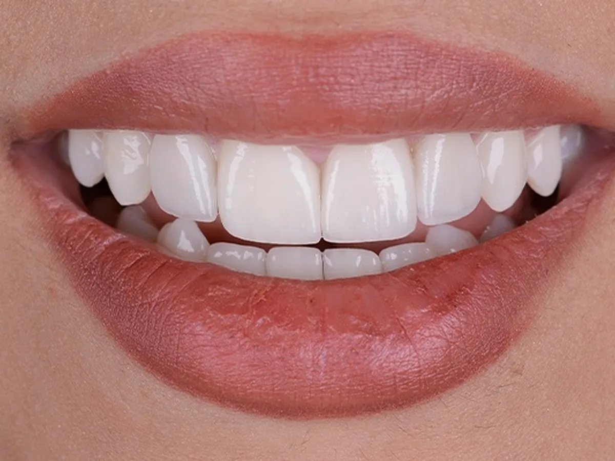 Smile design candidacy overview at Citydent Istanbul