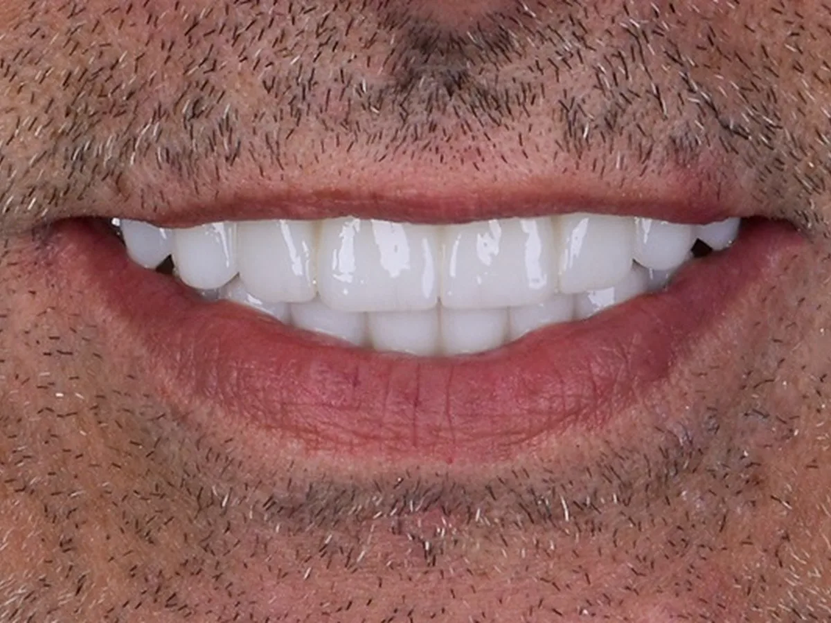 Smile design results at Citydent Istanbul Turkey