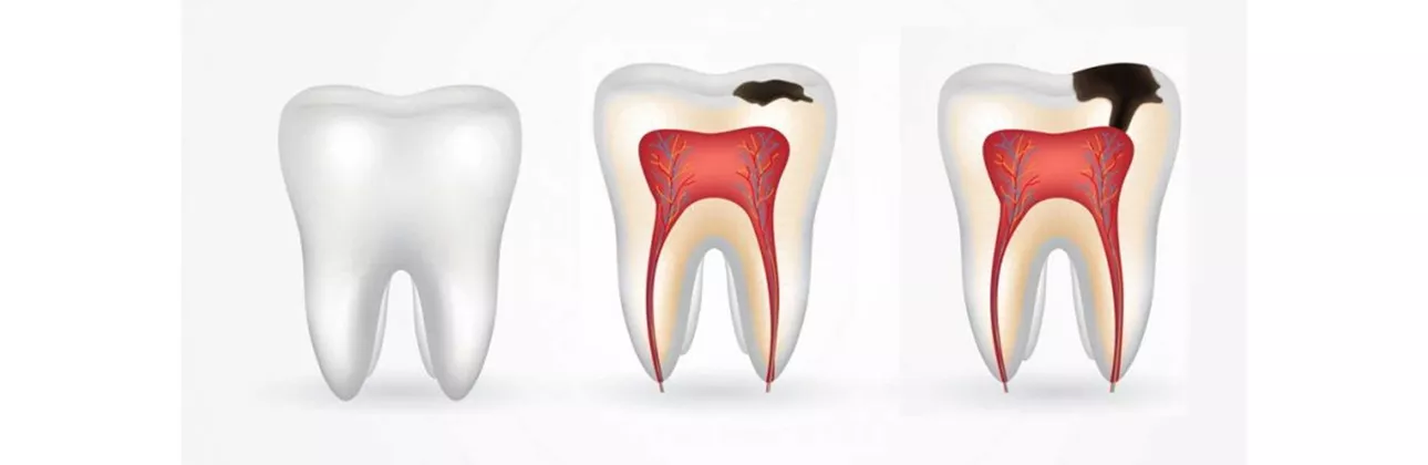 Tooth decay stages shown on dental model at CityDent Istanbul