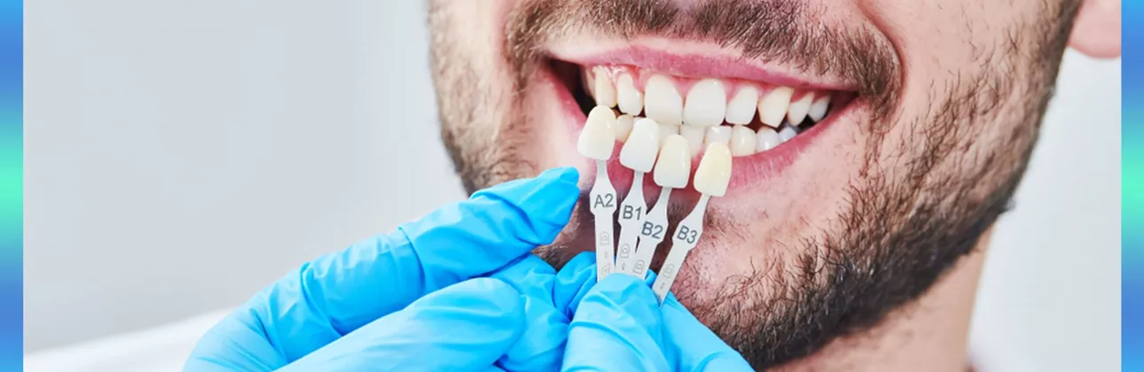 Scala delle tonalità per corone in zirconia con campioni di colore VITA Classic presso CityDent a Istanbul