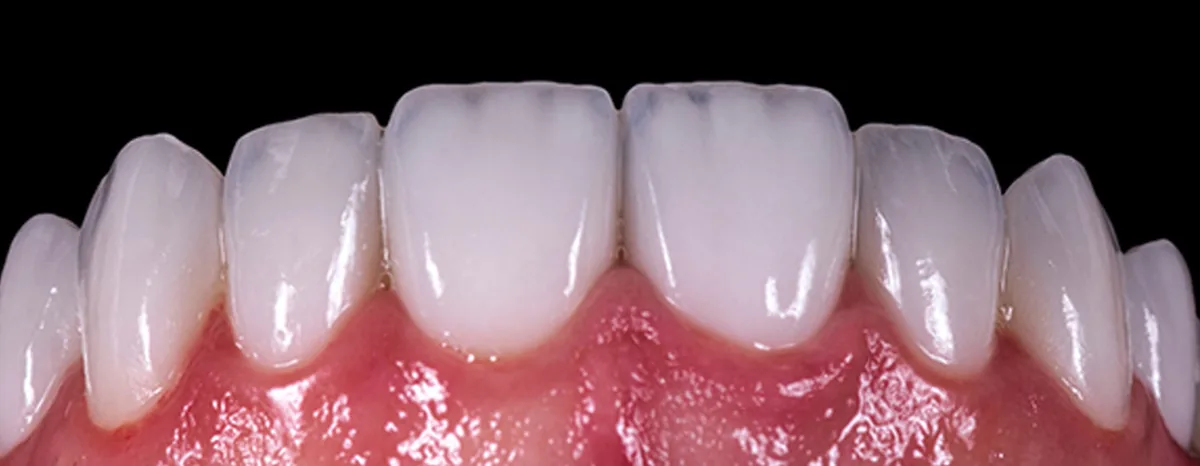 Zirconia crowns in Istanbul