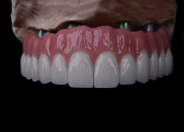 All-on-4 implant treatment in Istanbul