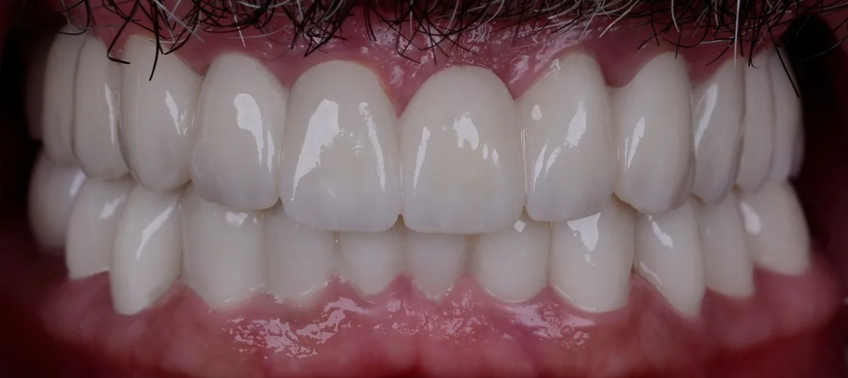 Advantages of monolithic zirconia crown Istanbul — strength and aesthetics