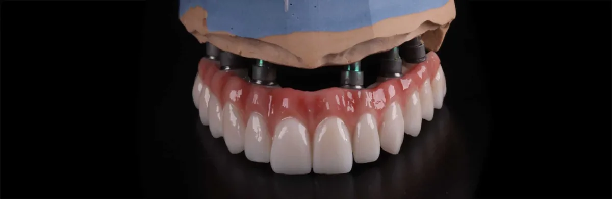 All-on-6 implant treatment in Istanbul