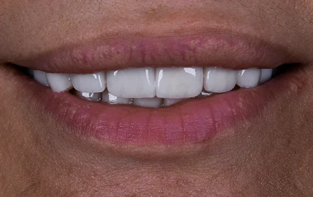 Monolithic zirconia crown treatment timeline Istanbul — CityDent