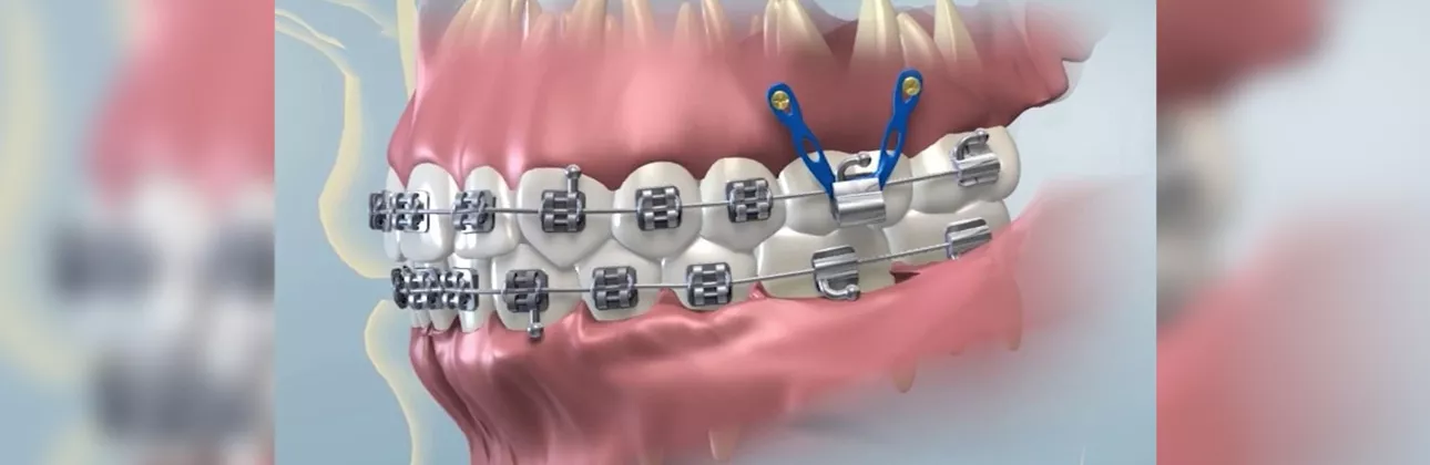 Kieferorthop&auml;disches Implantat als Anker für eine Zahnspange bei CityDent in Istanbul