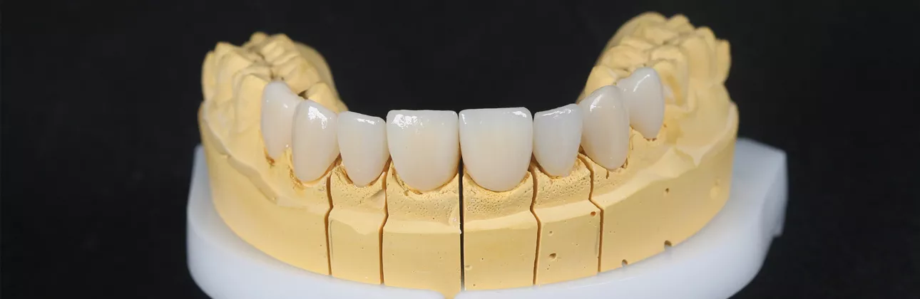 Sorriso ravvicinato per distinguere denti naturali dalle faccette presso la clinica CityDent a Istanbul