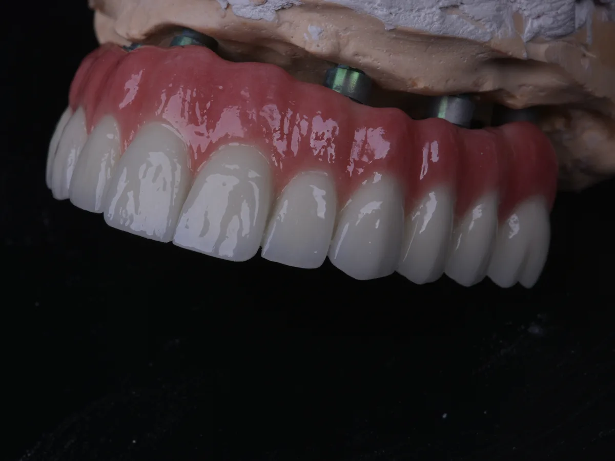 Implants all on 4 Istanbul – consultation arcade complète fixe