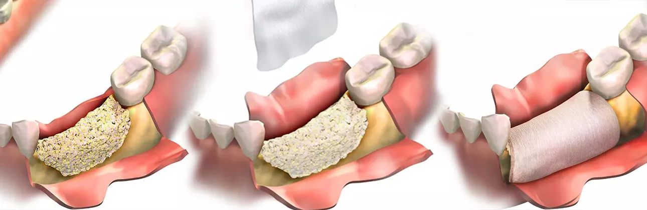 Procedura di innesto e membrana per la chirurgia implantare presso la clinica CityDent a Istanbul