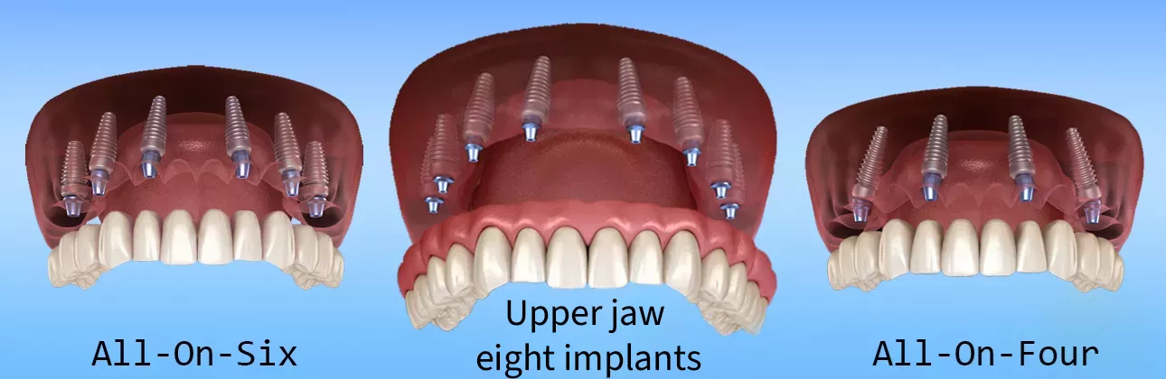 Verteilung der Implantate im Oberkiefer bei CityDent Istanbul