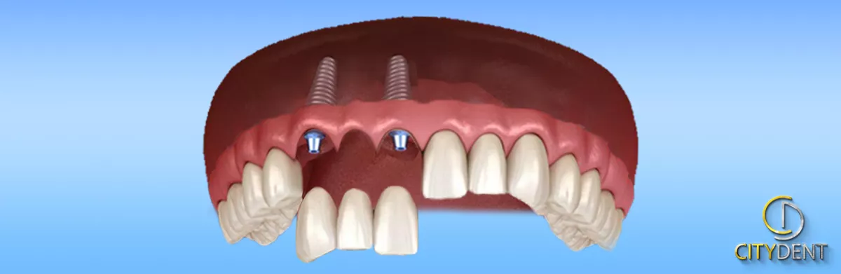 Stabile Verankerung der Implantate im Unterkiefer bei CityDent Istanbul