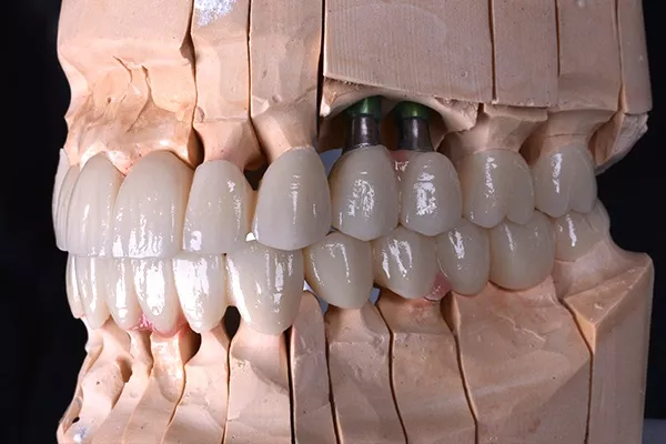 Solid zirconia crown preparation Istanbul
