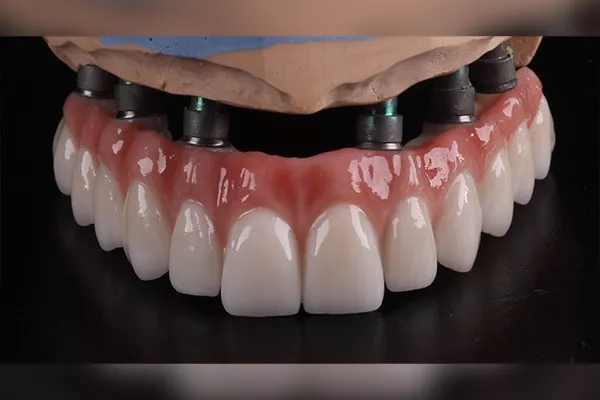 Monolithic zirconia crown Istanbul — CityDent dental clinic