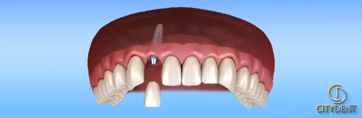 Einzelnes Implantat mit Krone für eine kleine Zahnl&uuml;cke bei CityDent Istanbul