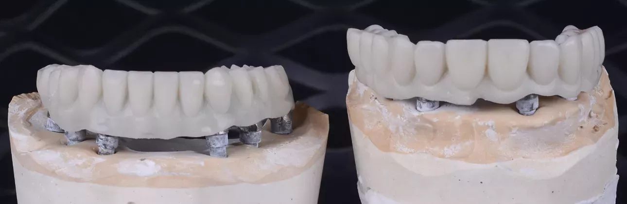 Consulto sui problemi della protesi temporanea presso la clinica dentale CityDent a Istanbul