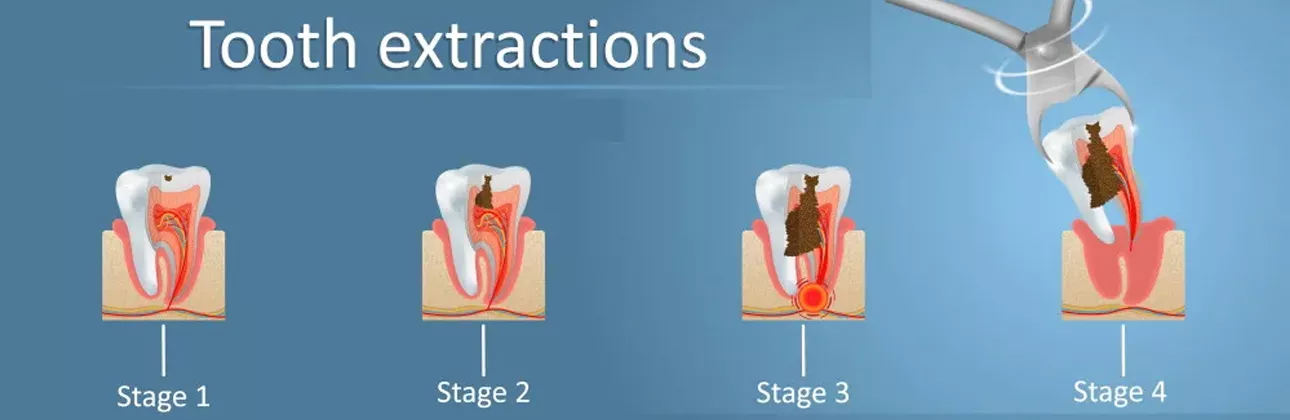 Procédure d'extraction dentaire chez CityDent Istanbul