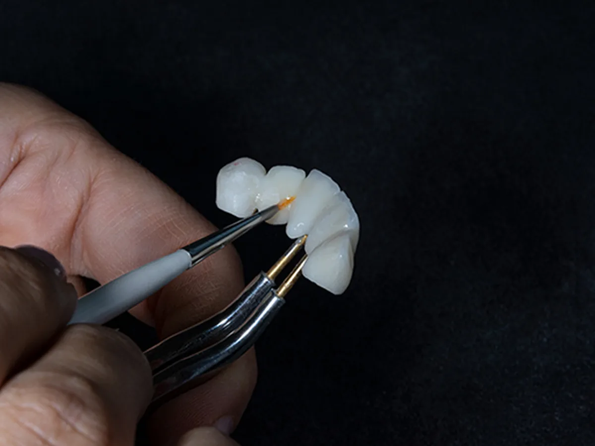 Confronto tra aspetto dei denti naturali e delle faccette a Istanbul