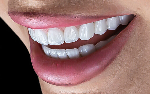تصميم الابتسامة وهوليوود سمايل